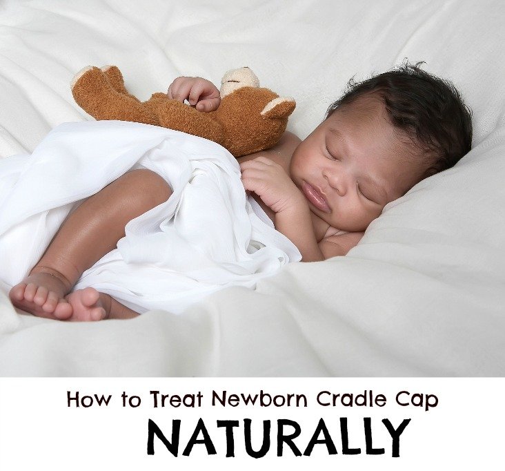 Cradle cap store remedies coconut oil