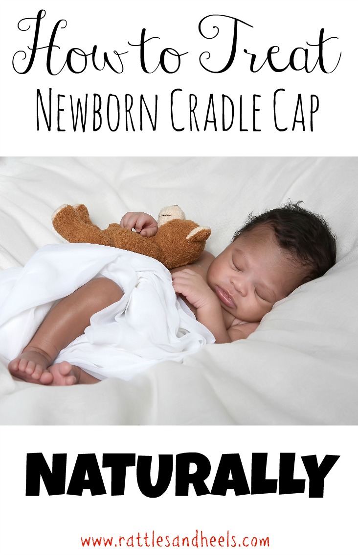 how-to-treat-cradle-cap